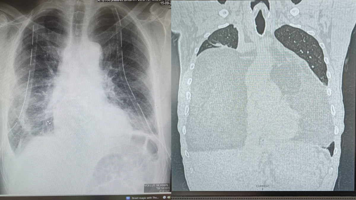 Tumor UKC RS