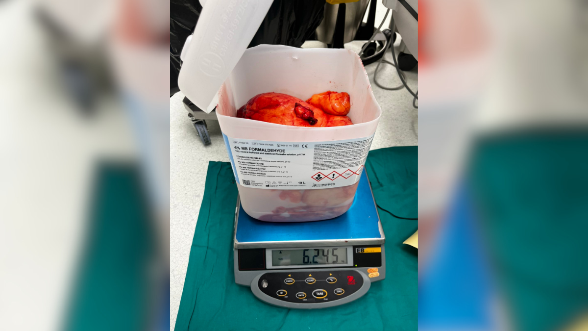 Tumor od 6 kilograma izvađen iz pacijenta na UKC RS