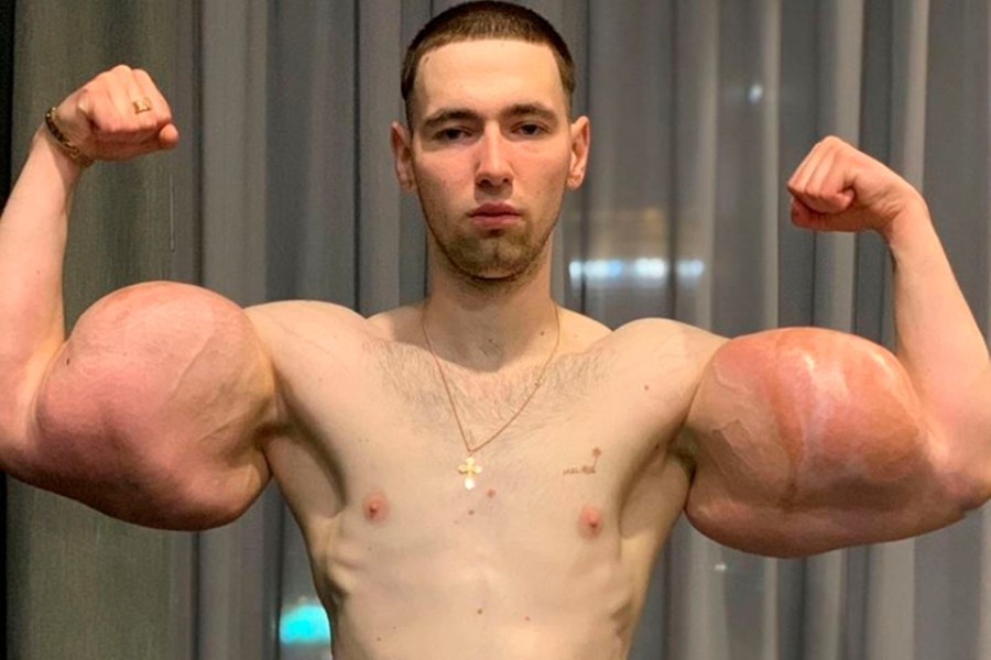 RIZIKUJE ŽIVOT ZBOG 'LAŽNIH MIŠIĆA', ruski MMA borac životno ugrožen