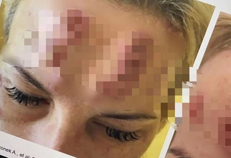 UZNEMIRUJUĆE FOTOGRAFIJE! Pazite kod koga radite BOTOKS: Kineski proizvod ostavlja JEZIVE posljedice! (FOTO)