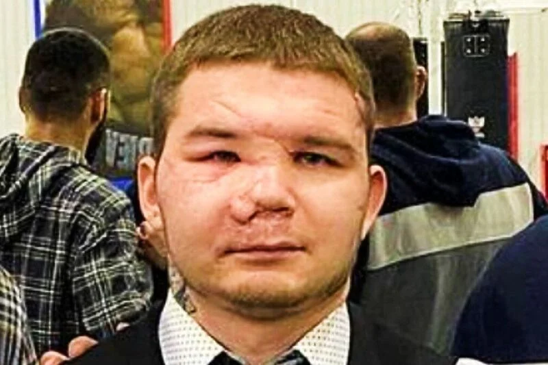 RUSKOM BOKSERU ĆE BITI REKONSTRUISANO LICE poslije napada medvjeda kojeg je ubio nožem (FOTO)