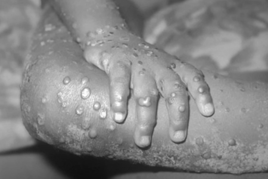 SVJETSKA ZDRAVSTVENA ORGANIZACIJA SPREMA ODGOVOR NA MAJMUNSKE BOGINJE Opsežne mjere suzbijanja epidemije se ne mogu porediti sa Kovid-19