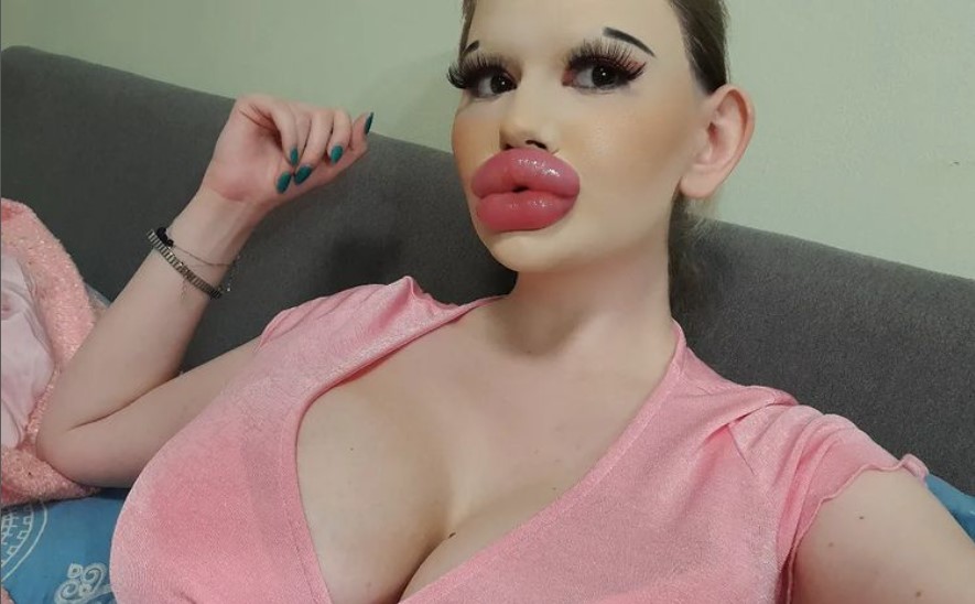 NAJVEĆE USNE NA SVIJETU Bugarka ubrizgala 30 inekcija hijaluronske kiseline (FOTO)