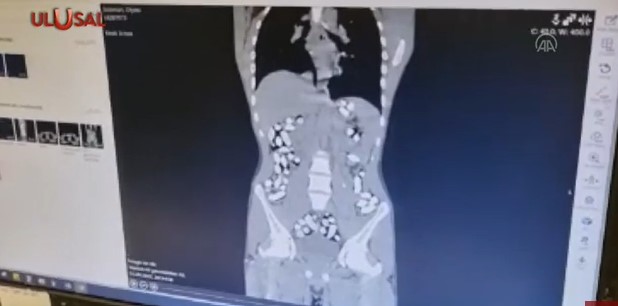 LJEKARI I POLICIJA U ŠOKU U tijelima pet Iranaca pronađeno sedam kilograma droge (VIDEO)