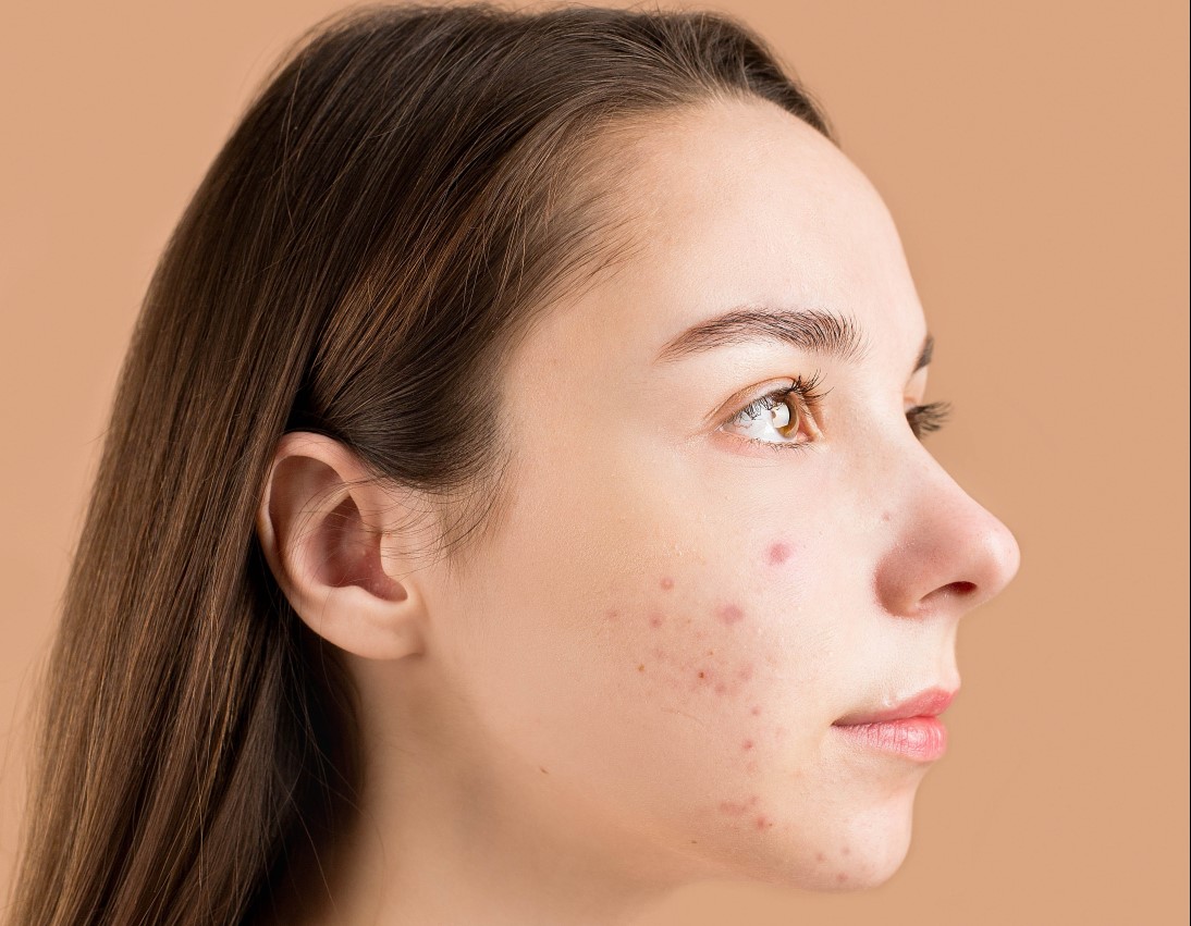 BESPLATNI DERMATOVENEROLOŠKI PREGLEDI Kampanja tokom marta, cilj podizanje svijesti o liječenju akni