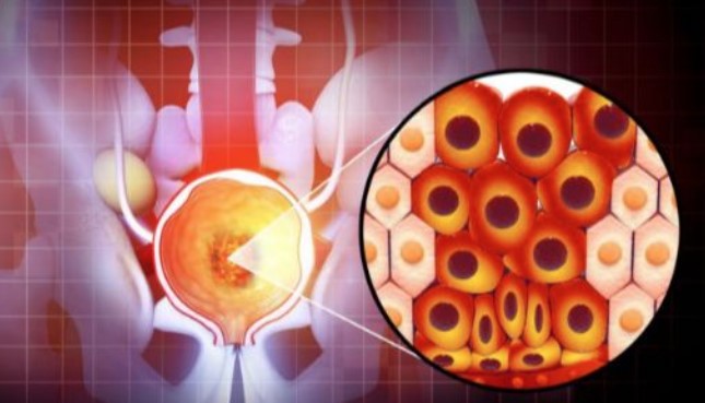 REVOLUCIONARNO OTKRIĆE! Napravljen novi test krvi koji otkriva rak prostate sa 94 posto tačnosti
