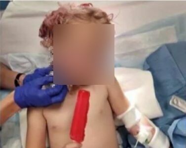"IZGLEDAM KAO ČUDOVIŠTE" Petogodišnju djevojčicu napao pas, zamalo izgubila oko