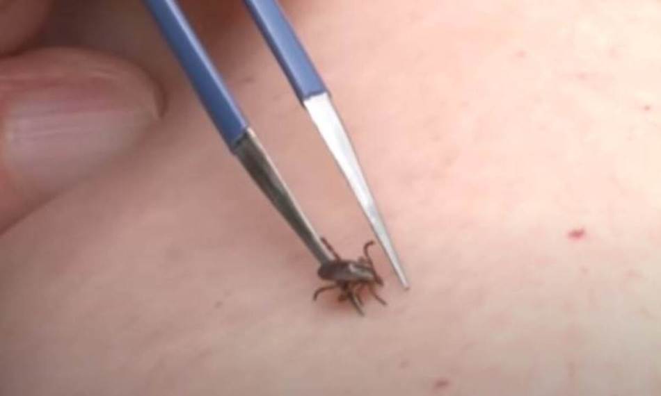Žena iz Sjeverne Makedonije umrla nakon ujeda krpelja