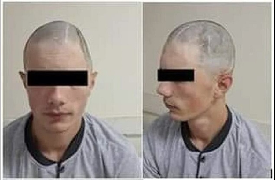 Zenički neurohirurzi mladiću ugradili dio lobanje izrađen na 3D printeru