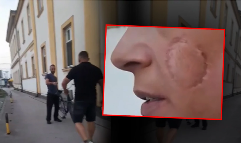 UHAPŠEN NASILNIK KOJI JE UGRIZAO BIVŠU ŽENU Imao zabranu prilaska, ali policija nije reagovala na to