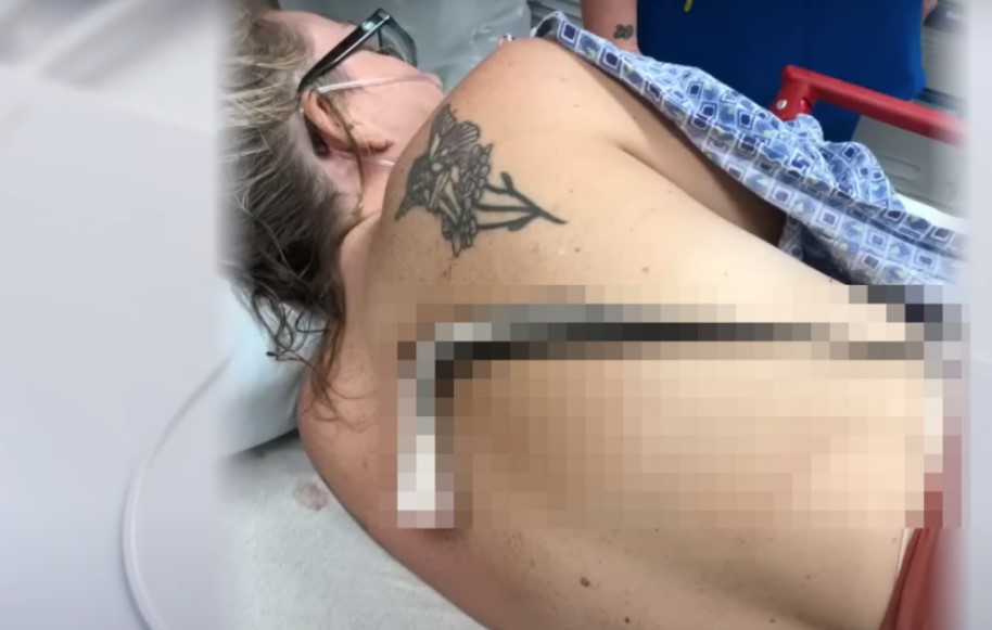 (UZNEMIRUJUĆI VIDEO) Ženu u valovima napala riba, bodlja joj se zabola u leđa