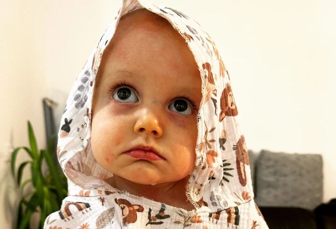 PRIČA OD KOJE BI KAMEN ZAPLAKAO Mali Viktor je “dijete leptir”: Tijelo mu je prekriveno otvorenim ranama, ima 15 mjeseci i ne može da prohoda jer mu koža stalno puca (FOTO)