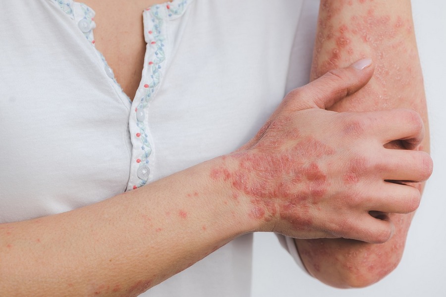 SVJETSKI DAN PSORIJAZE Hroničnoj kožnoj bolesti još nije poznat uzročnik