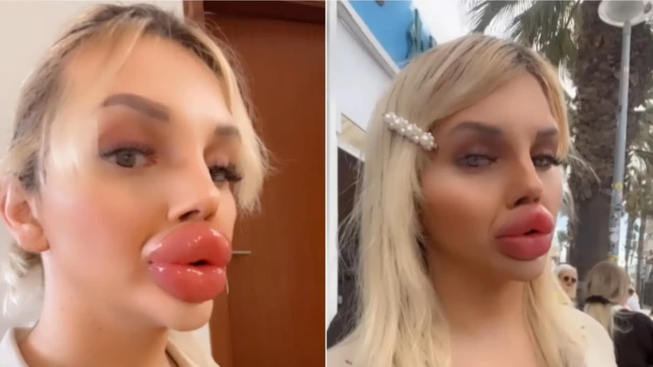 Influenserka postala ovisnica o filerima za usne: “Ispijanje pića mi je herkulovski zadatak” (VIDEO)