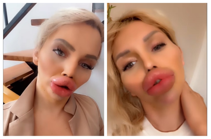 DA LI MOŽE BIZARNIJE? Potrošila hiljade evra za ogromne usne, više ne može ni da jede, ali ne planira da stane sa operacijama (VIDEO)