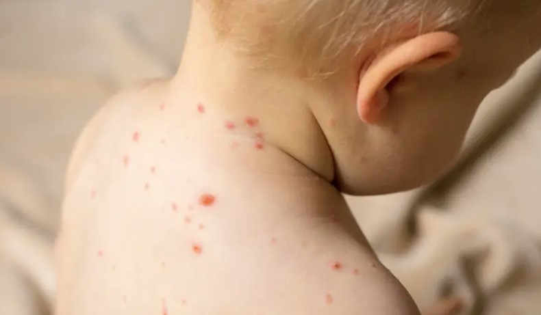 VAKCINACIJA NAJVAŽNIJA MJERA Rodić Vukmir: Jedna osoba može da virus morbila prenese na drugih 20