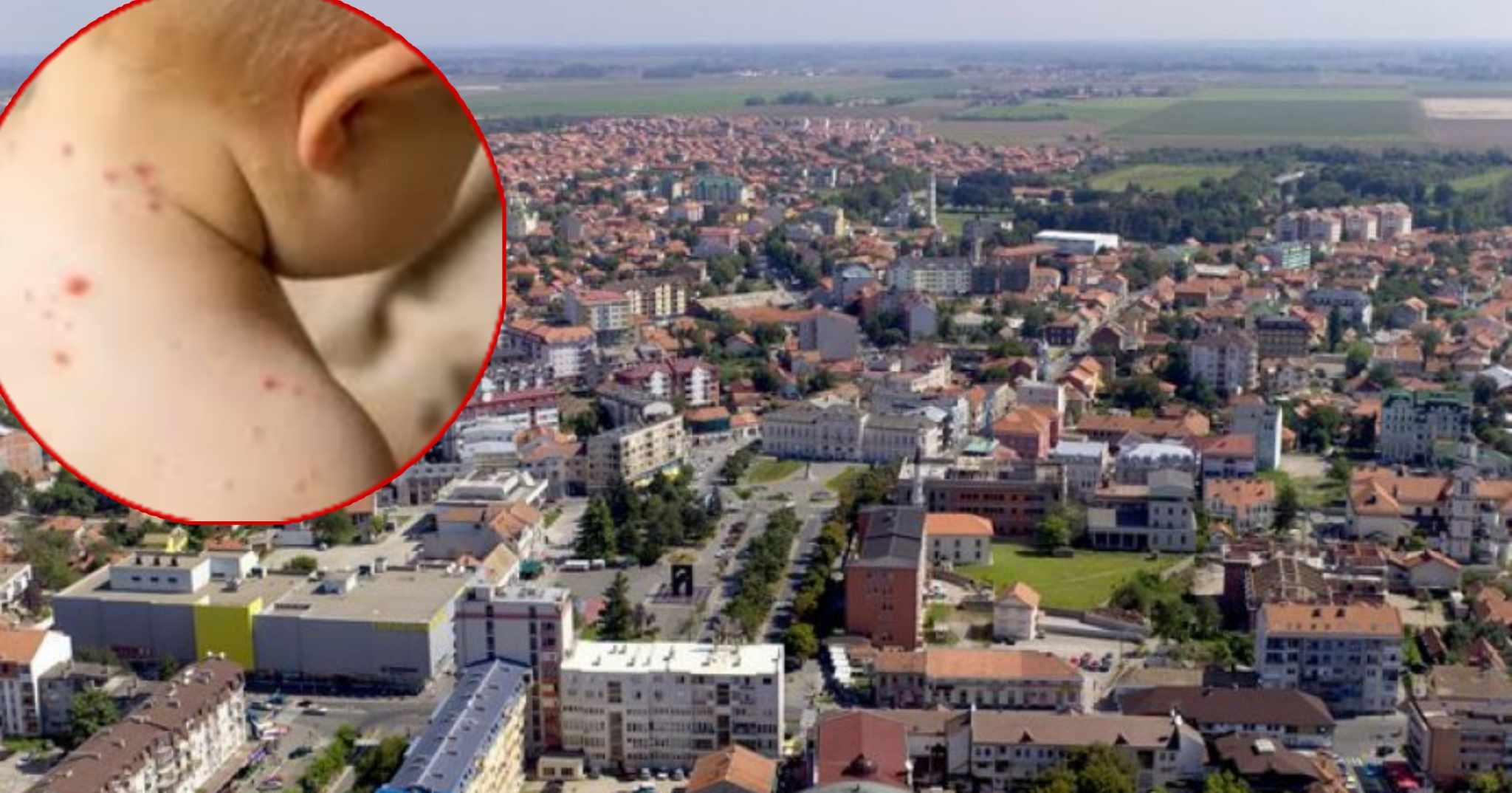 NAJVIŠE U BIJELJINI Morbilima u Srpskoj zaraženo više od 240 osoba