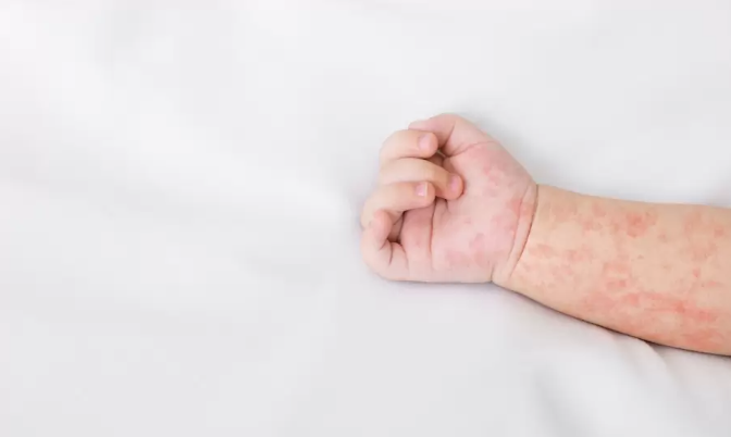 BROJ RASTE! U Srpskoj 21 oboljelo od morbila