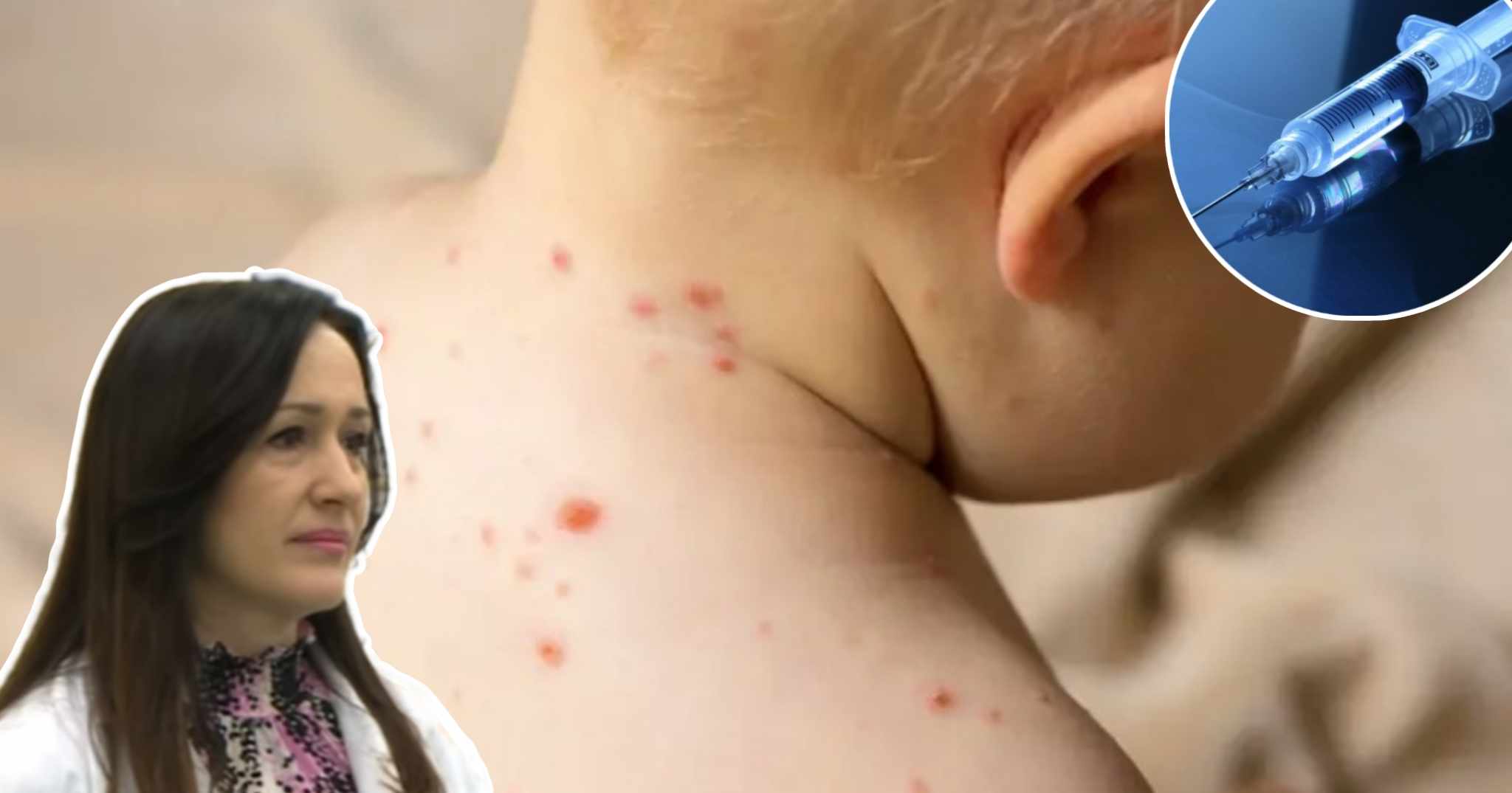 MMR VAKCINA NAJVAŽNIJA MJERA Rodić Vukmir za ALOnline o zarazi morbila: Potreban nam je visok obuhvat imunizacijom da bismo spriječili nastanak epidemije
