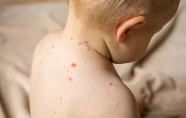 SITUACIJA ESKALIRALA Država iz regiona proglasila epidemiju morbila