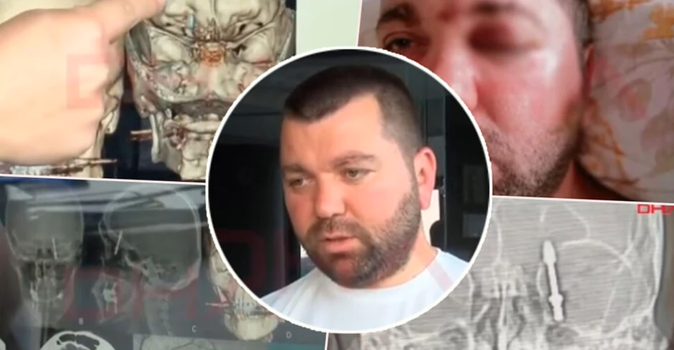 (UZNEMIRUJUĆE FOTO/VIDEO) ČOVJEK PREŽIVIO UŽAS KOD ZUBARA Implant mu probio kost i završio u mozgu, on vrištao od bolova: Usljedila hitna opeacija