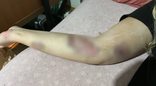 ZADOBILI TEŠKE POVREDE Radnici obezbjeđenja brutalno pretukli bračni par u kafani