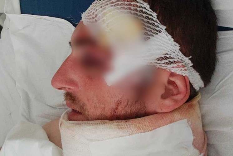(UZNEMIRUJUĆE FOTOGRAFIJE) BRUTALNO PRETUČENOM MLADIĆU U ZVORNIKU NAPUKNUTA LOBANJA Oglasio se iz bolnice i otkrio šta stoji u pozadini incidenta "Moj život je ugrožen"