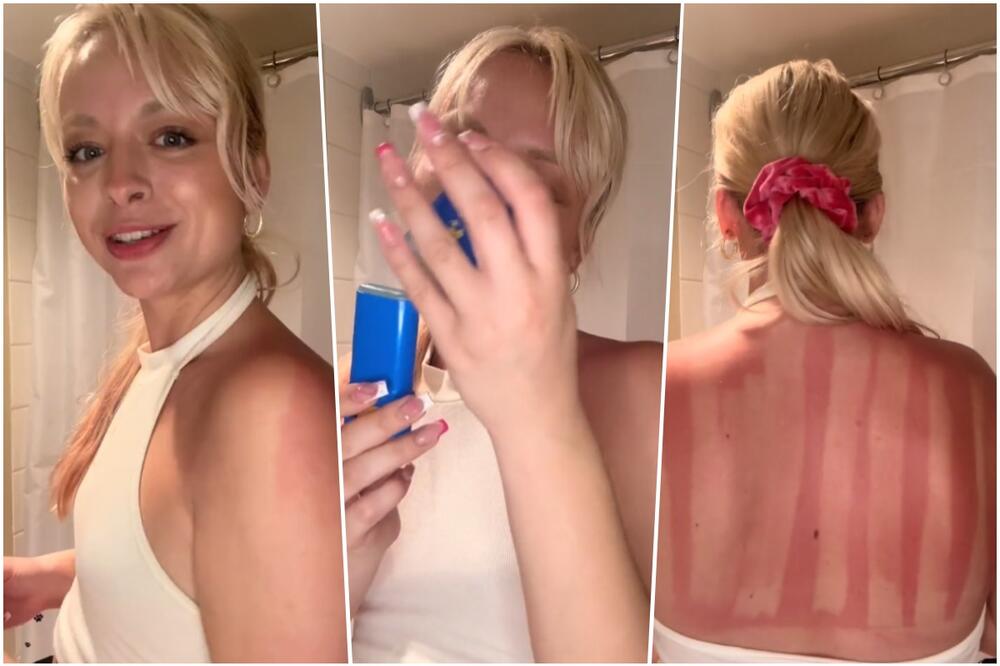 (VIDEO) JEZIVE OPEKOTINE NAKON SUNČANJA Djevojka nanijela kremu za sunčanje, ali je zaboravila da uradi jednu stvar