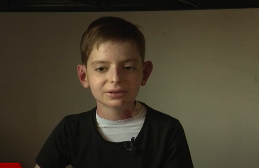 ZA SVAKU POHVALU Srbija među devet zemalja u svijetu koje su nabavile lijek za djecu leptire