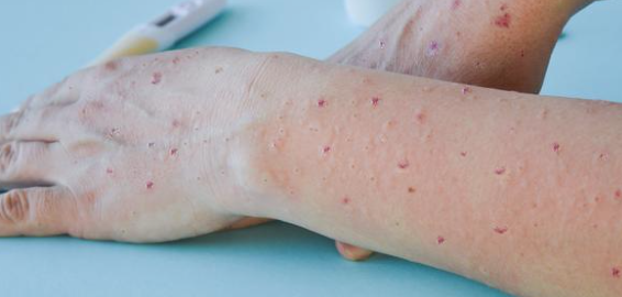 ZARAŽENO SKORO 20.000 LJUDI Epidemija mpoksa može biti zaustavljena za 6 mjeseci