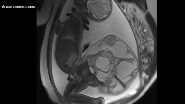(UZNEMIRUJUĆA FOTOGRAFIJA) "BILO JE ZASTRAŠUJUĆE VIDJETI TO NA ULTRAZVUKU" Beba rođena s tumorom od 1,8 kg na trtičnoj kosti