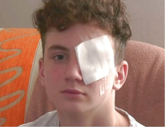 Petnaestogodišnjak ostao bez oka i dijelova prstiju nakon eksplozije petarde