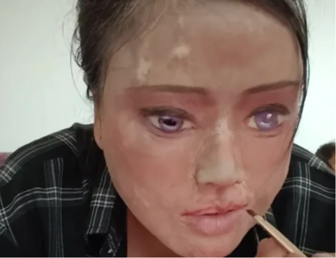 "Oči crtam šminkom jer svoje više nemam": Pobjegla od muža nasilnika, ali je uspio da je nađe i unakazi za cijeli život