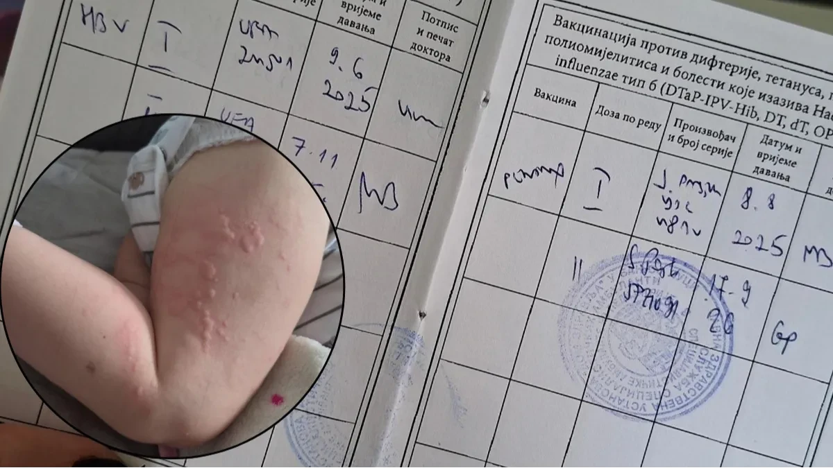 Dječak u Banjaluci umjesto HBV-a dobio Pentaxim na koji je alergičan, sestra se pravdala "stresom" (FOTO)