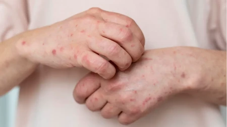 Hitno upozorenje porodicama koje putuju u Španiju zbog porasta slučajeva morbila