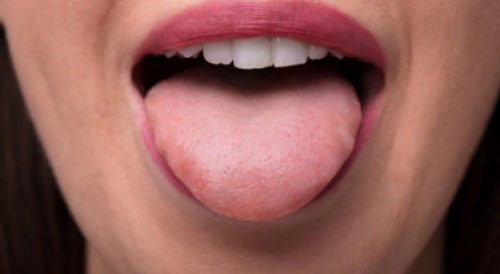 OBRATITE PAŽNJU: Ove promjene u ustima mogu da ukazuju na visok holesterol