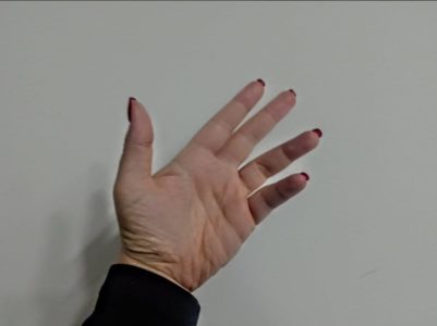 KAKO PREPOZNATI POVIŠEN HOLESTEROL: Ako primijetite ovaj simptom na prstima, potražite pomoć ljekara