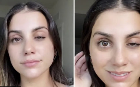 JEZIVO! DOBRO PAZITE ŠTA RADITE ZA LJEPOTU: Otišla na botoks zbog bora na čelu, sada ne može otvoriti oko (VIDEO)