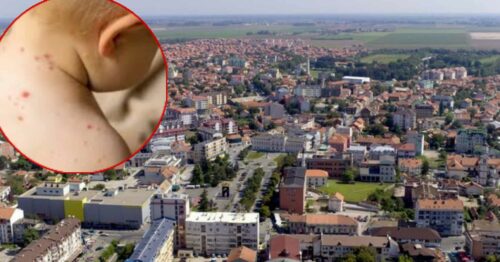 NAJVIŠE IH JE U BANJALUCI I BIJELJINI Broj zaraženih morbilama u Srpskoj samo raste